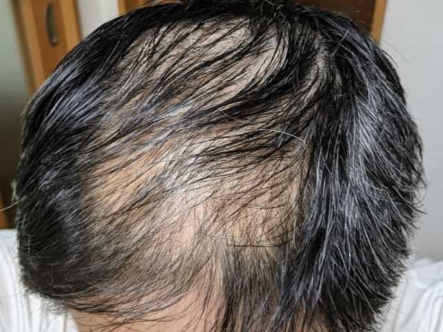 大豆イソフラボン　男性　効果　薄毛の抑制　育毛の促進